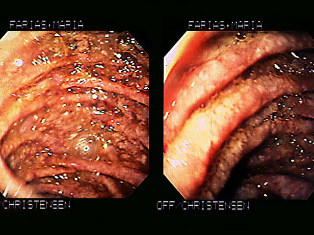 Small intestine: (MAI), endoscopic view