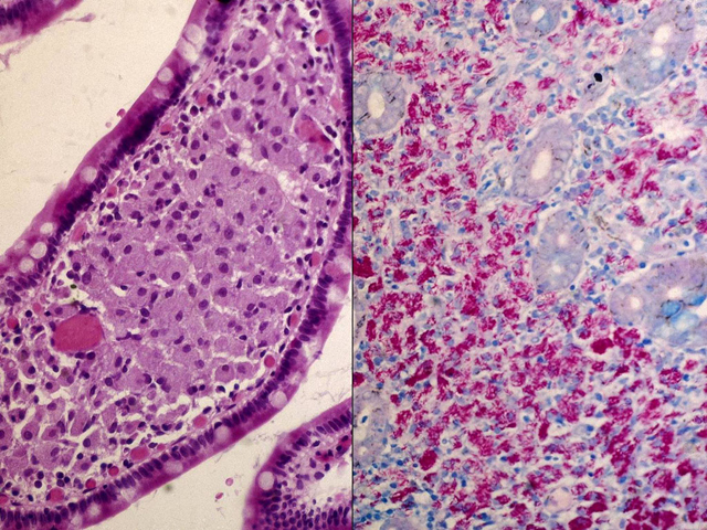 Small intestine: MAI infection, H & E and AFB stain