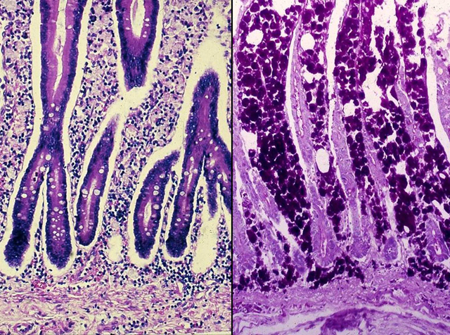 Whipple's Disease, H&E and PAS stain