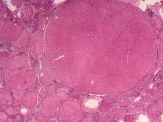 Cirrhosis, H&E