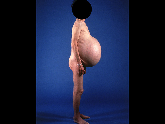 Ascites, clinical photograph