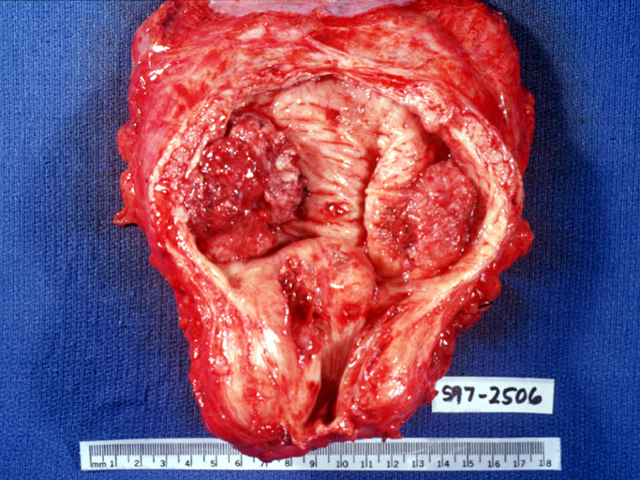 squamous cell carcinoma bladder gross